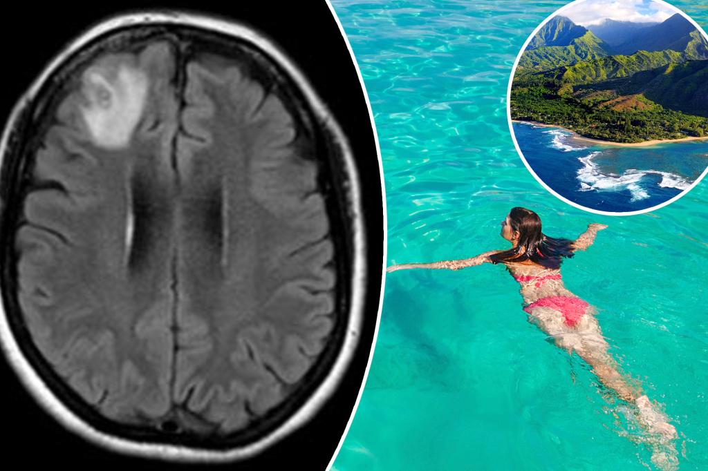 Woman, 30, infected by brainworms after traveling to Hawaii
